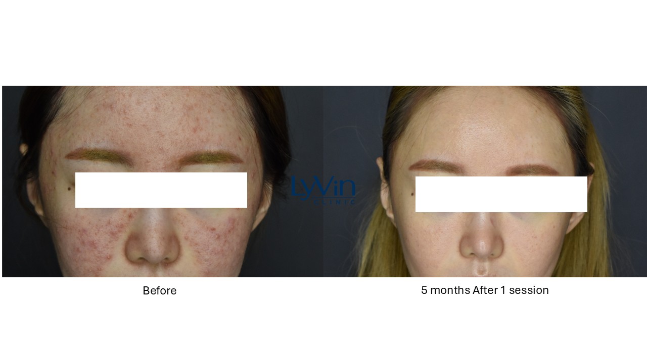 Skinvive before and after photo showing improved skin hydration and glow